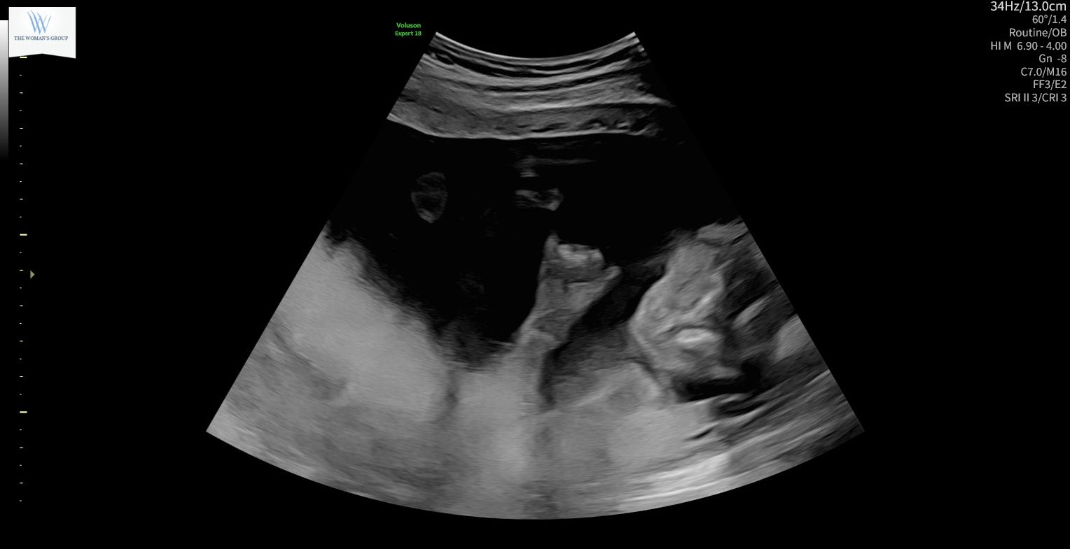 Ultrasound scan of the baby